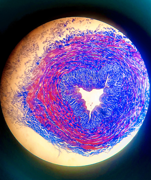 Circle with blue, purple and pink dots in it depicting the inside of an artery with a heart shaped hole in it
